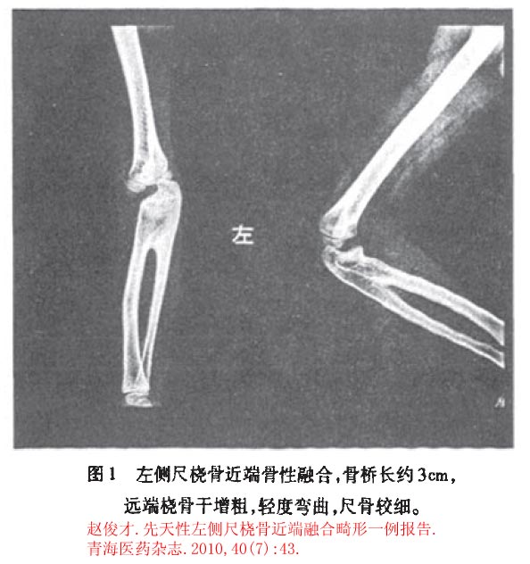 cl2622:先天性尺桡骨融合畸形