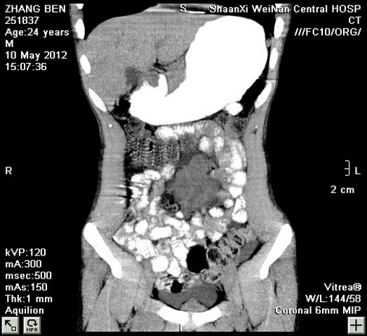 cl2614:肠系膜淋巴结结核,显性脊柱裂.