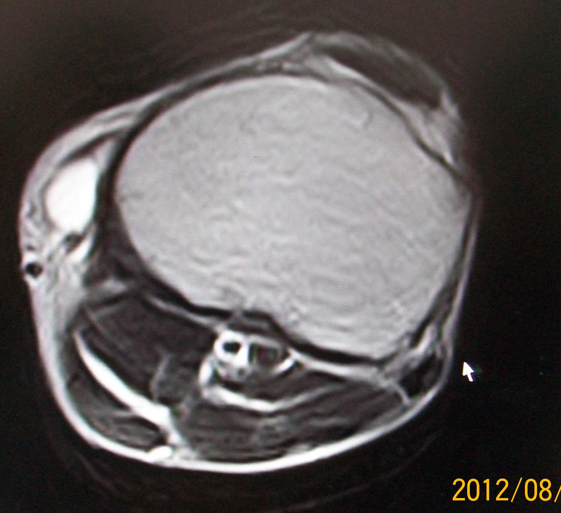 大家看一看是不是腱鞘囊肿. mri  关节  膝关节