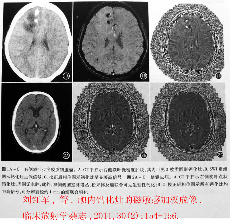 个人认为,相位图在显示钙化方面明显优于幅度图像,下面几例颅内钙化灶