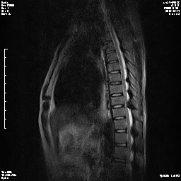 mri5556:男38 全身多关节受累 强直性脊柱炎吗