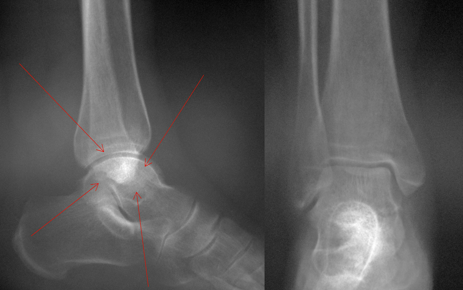 x12130:踝关节高密度 - x线病例讨论 医影在线