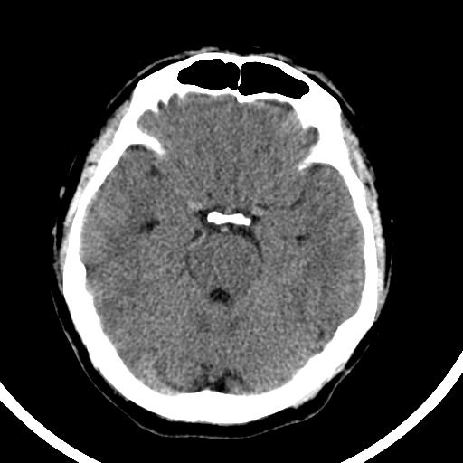 ct41948:男,36y,头颅ct会诊 右侧乙状窦有病变吗?