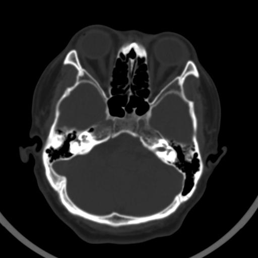 ct41948:男,36y,头颅ct会诊 右侧乙状窦有病变吗?