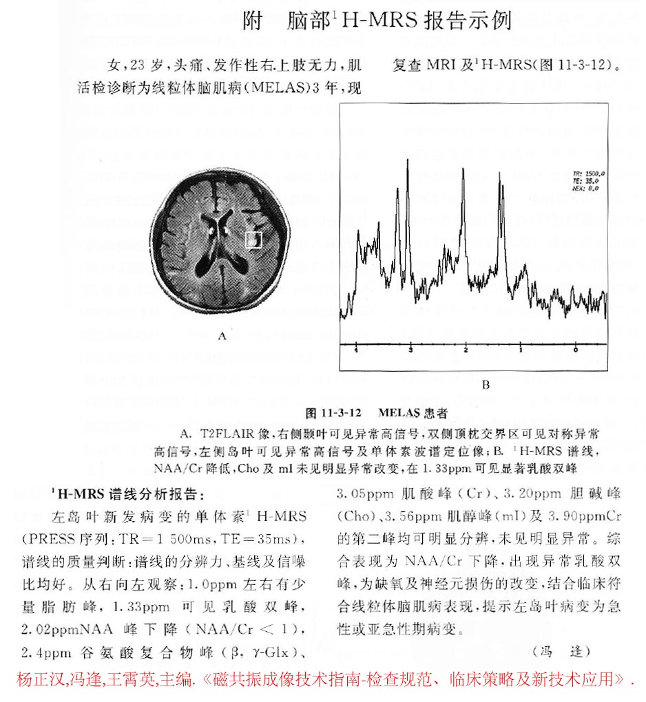 磁共振波谱成像技术mrs02如何阅读mrs谱线