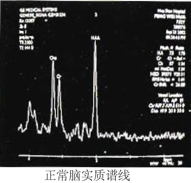 磁共振波谱成像技术mrs02如何阅读mrs谱线