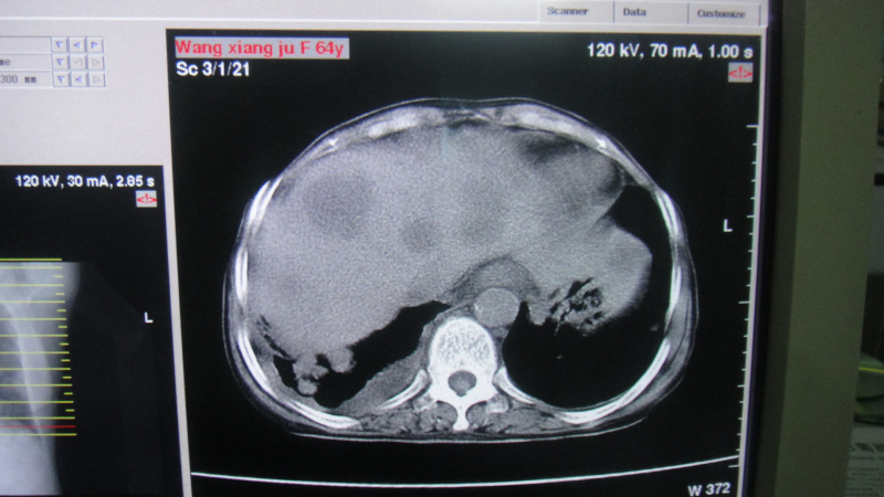 ct42417:男,64岁,食管癌并双肺,肝内多发转移!