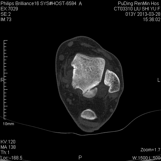 ct42556:请各位老师看看:踝关节ct 急!急!急!