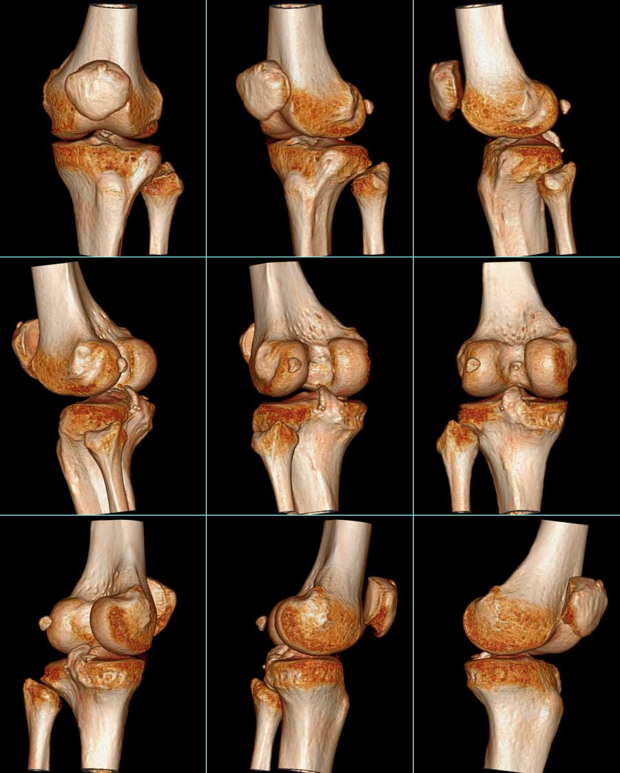 ct42259f60膝关节扭伤疼痛肿胀半月局部肿胀活动受限