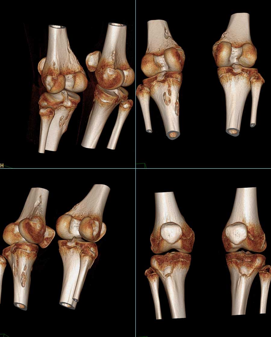 ct42260f15左侧膝关节外伤后不适两月