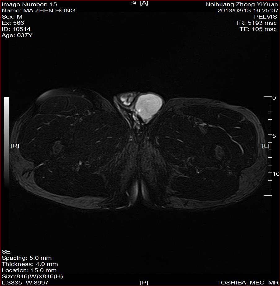 mri5723b超部分报精原细胞瘤部分报睾丸增大