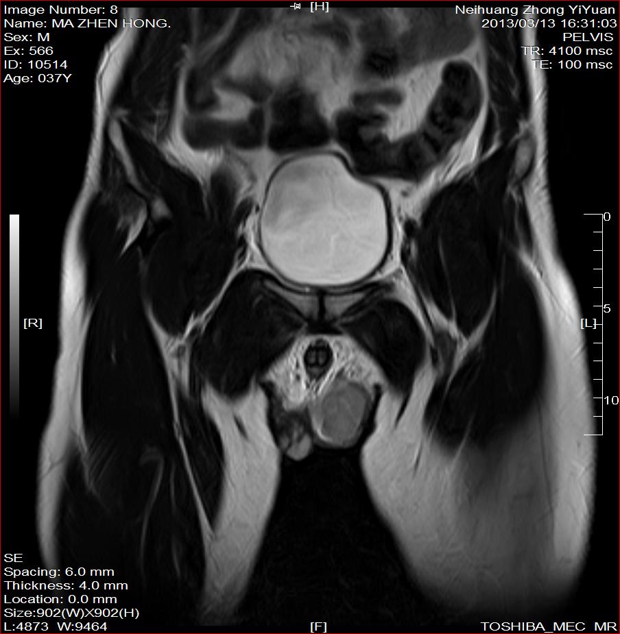 mri5723:b超部分报精原细胞瘤,部分报睾丸增大