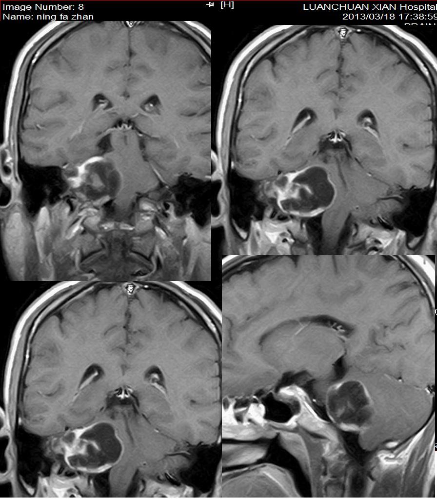 mri5730:听神经瘤 看看是不