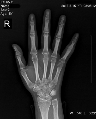 x12226:右手指骨质破坏.
