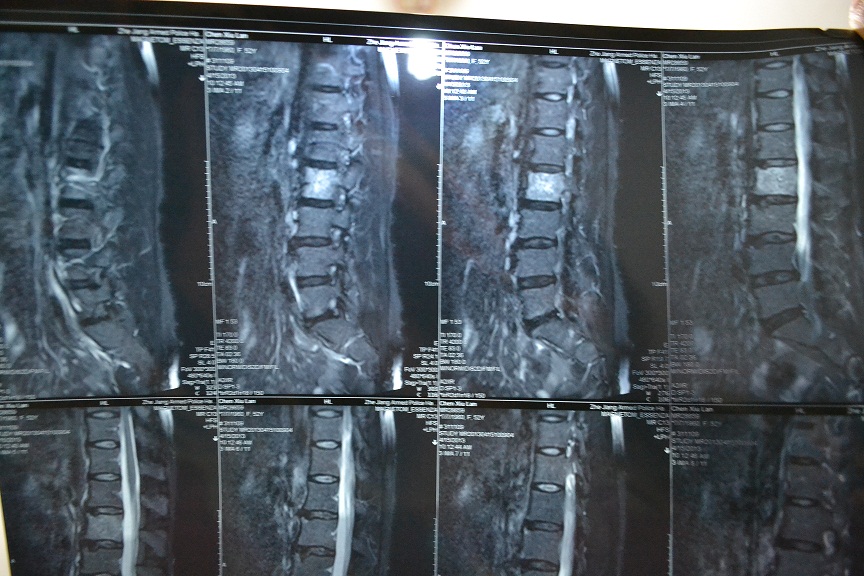 腰椎退变,l2-4椎体上缘许莫氏结节.l5/s1椎间盘变性,l4/5