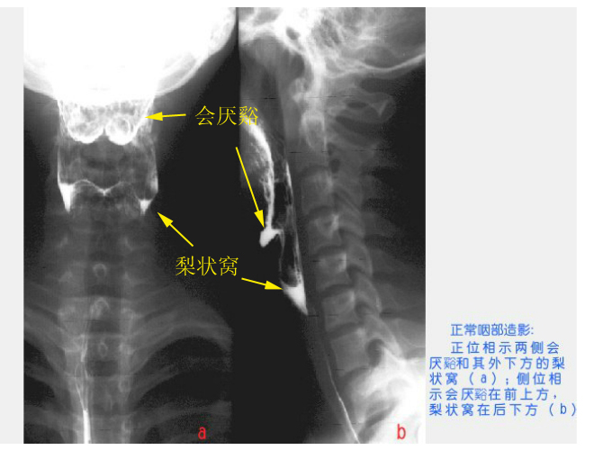 会厌溪是怎么回事?