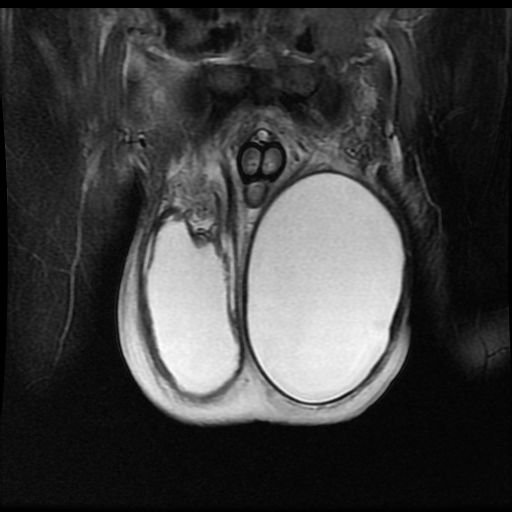 mri5781:m69挑重物后双侧阴囊肿大,彩超提示鞘膜积液.