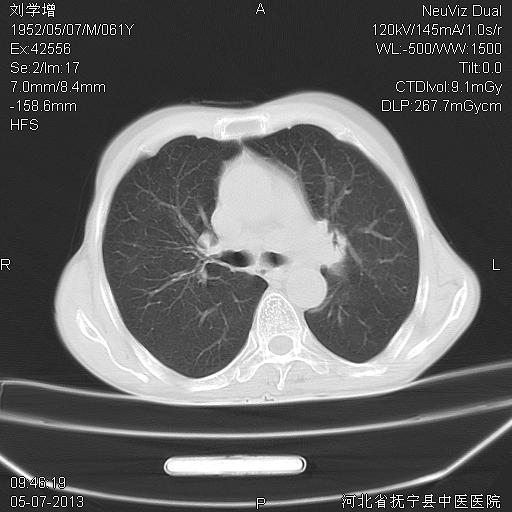 ct43223:左侧肺门增大 - ct病例讨论 医影在线