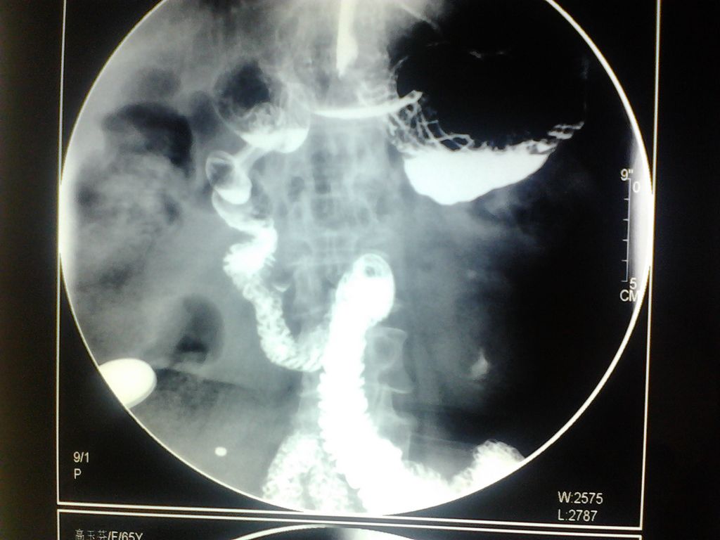 社区 69 影像读片 69 x线病例讨论 69 x12378:胃扭转