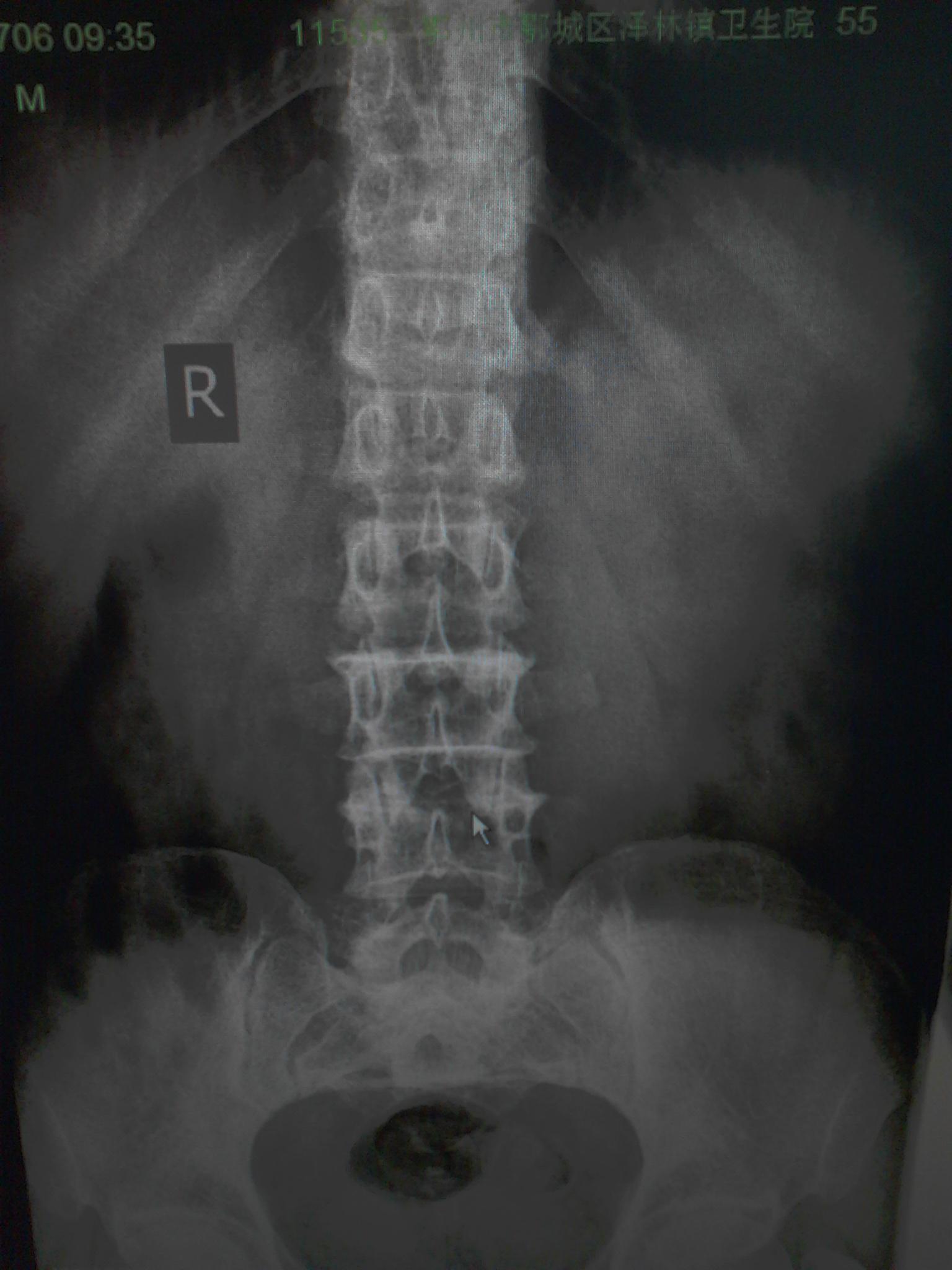 x12591:移行椎 - x线病例讨论 医影在线