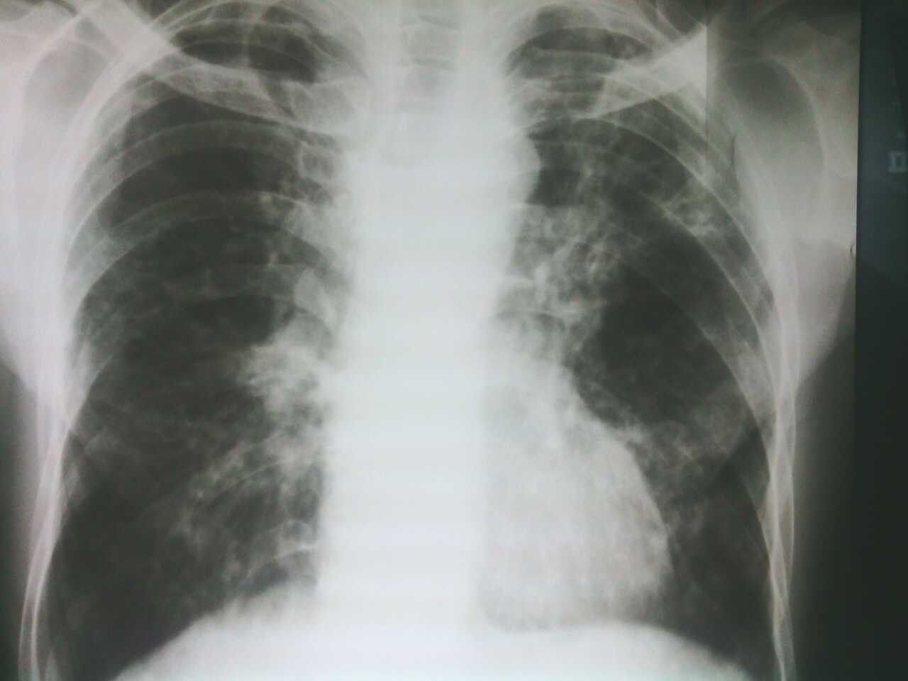 x12885胸片继发性肺结核