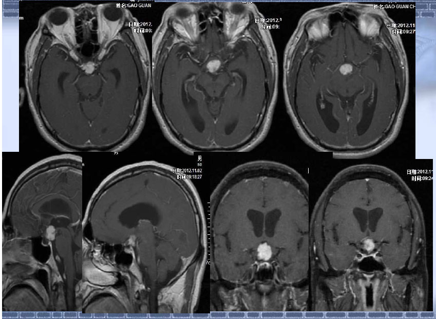 颅咽管瘤(鞍区)