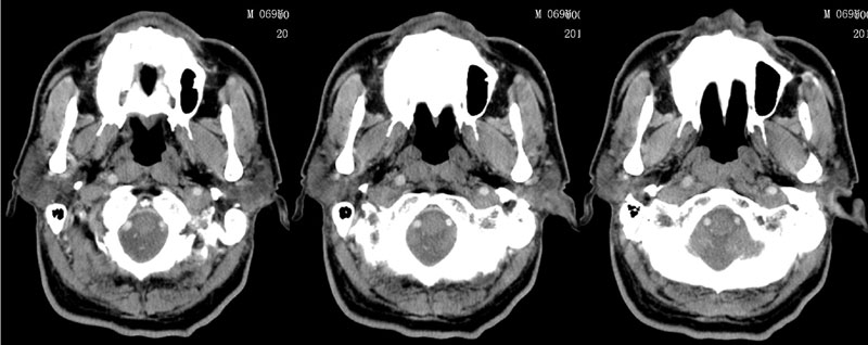 ct46324男性69岁反复口咽部肿物10年明显增大1月