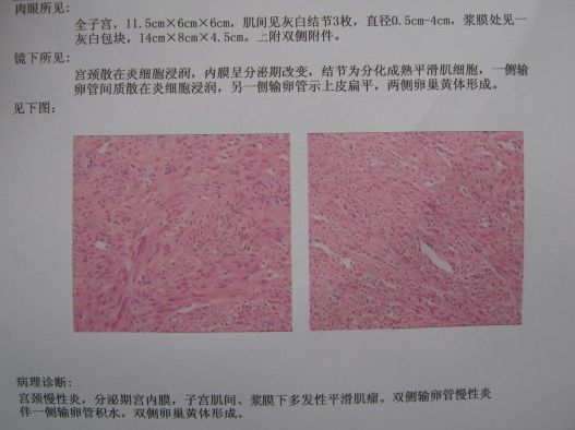 69 影像读片 69 结果反馈(病例 69 mri3905:多发子宫肌瘤 病理