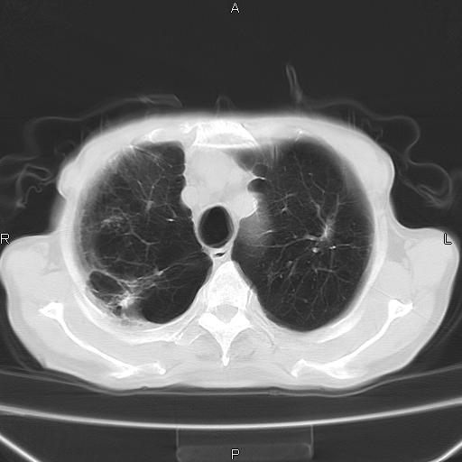 ct47686:慢性,肺气肿,肺纤维化,胸腺瘤,右肺占位?