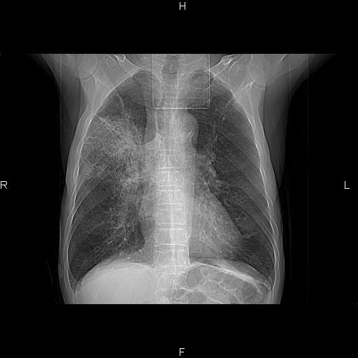 ct47686:慢性,肺气肿,肺纤维化,胸腺瘤,右肺占位?