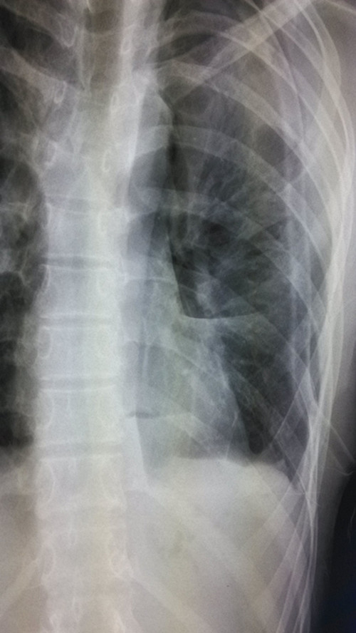 x13266:气胸术后胸片