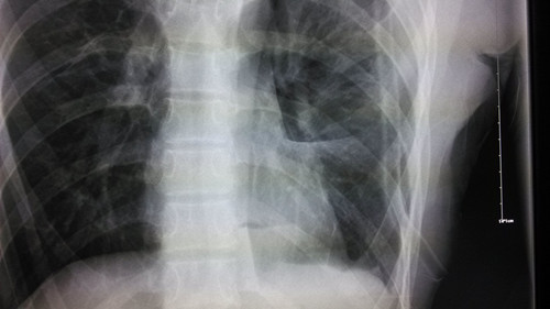 x13266:气胸术后胸片 - x线病例讨论 医影在线