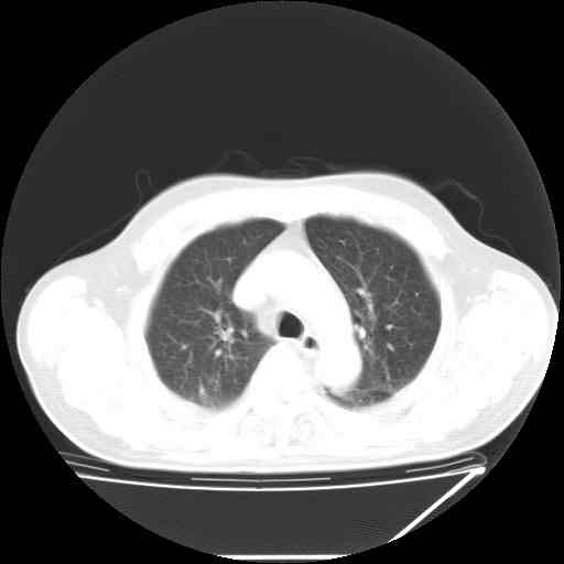 ct48292男67岁咳嗽白色泡沫痰一周右肺上叶后段还是下