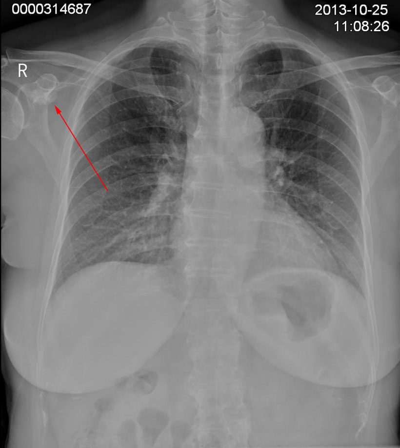 69 x13485:右肩胛骨占位   这个病例dr我们漏诊了,ct也差点漏诊