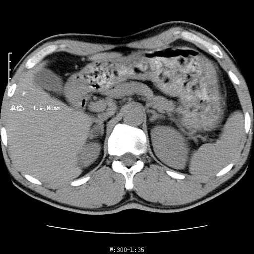 mri6418:肾上腺lava