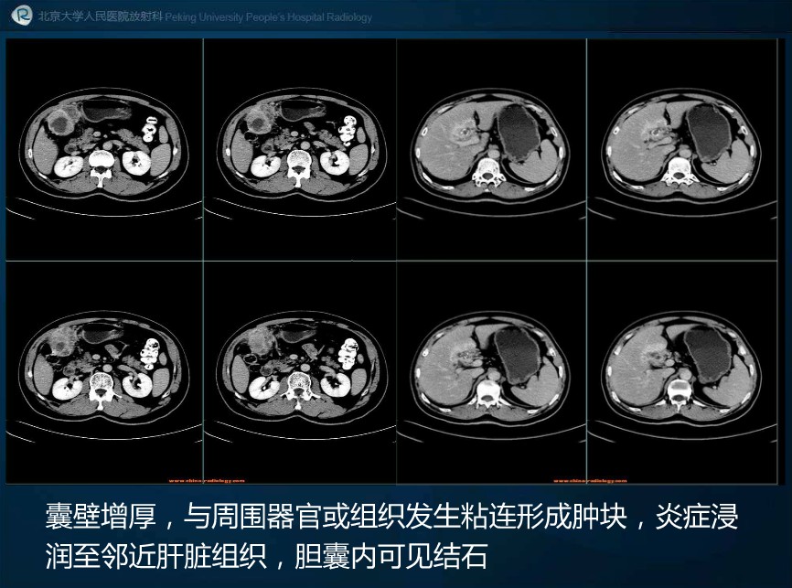 ct49151:黄色肉芽肿性胆囊炎