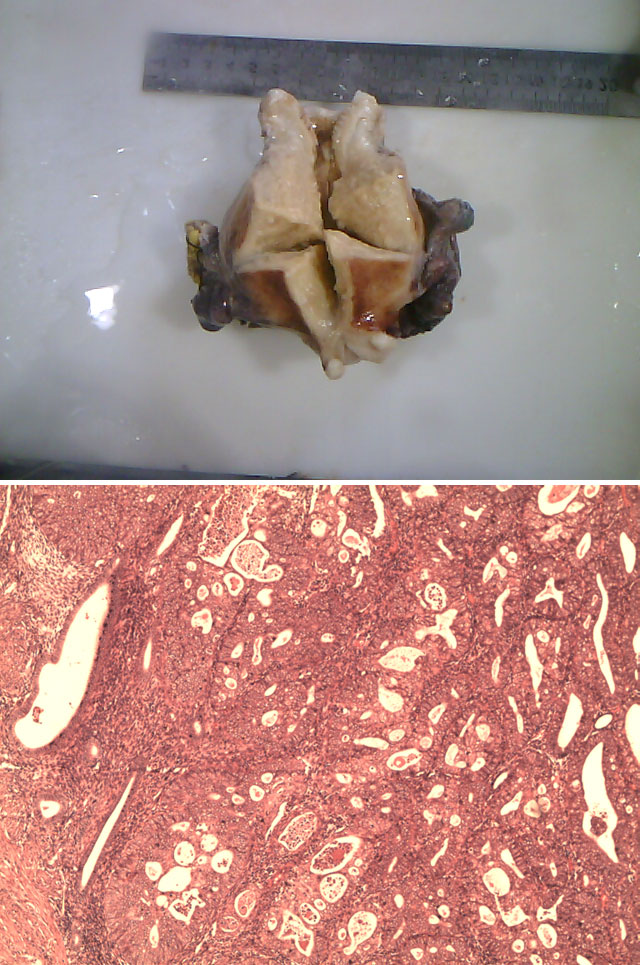 子宫内膜癌(中分化子宫内膜样腺癌)