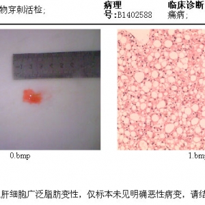 局灶性脂肪肝