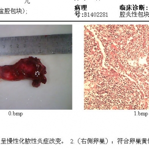 输卵管脓肿