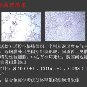 朗格罕组织细胞增生症