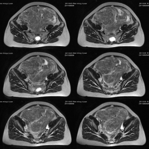 子宫肌瘤（阔韧带肌瘤）