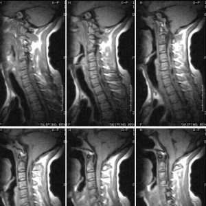 CHiari 畸形并脊髓空洞