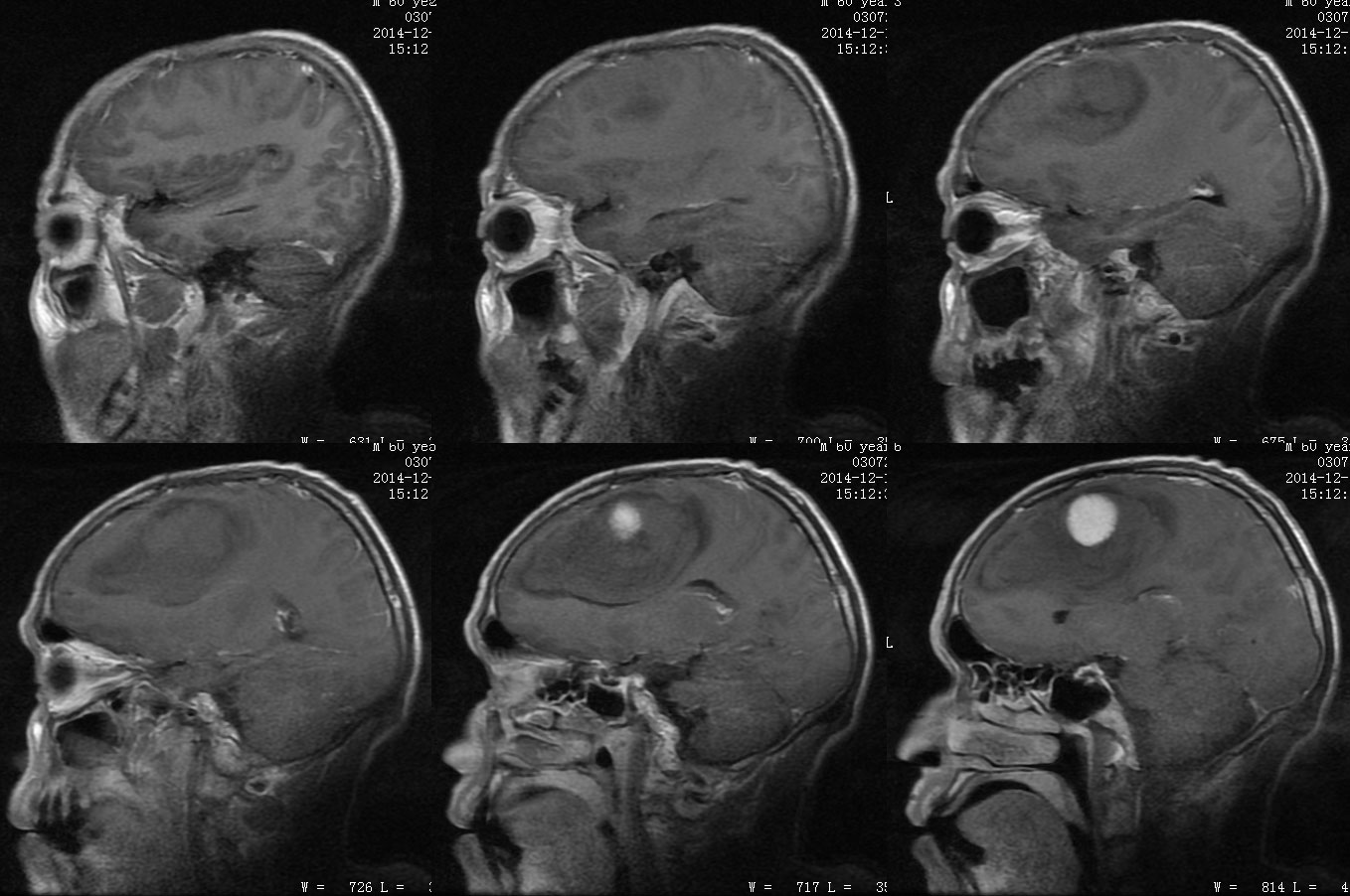 血管瘤型脑膜瘤(或脑膜血管周细胞瘤(大脑镰旁)