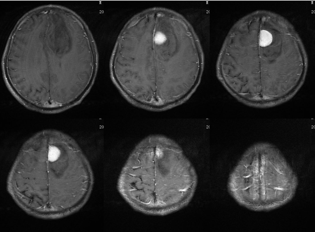 血管瘤型脑膜瘤(或脑膜血管周细胞瘤)(大脑镰旁)