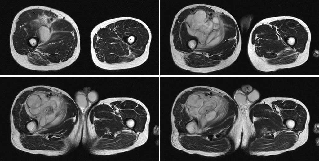 肌间纤维肉瘤(大腿 骨,关节,肌肉 医影在线