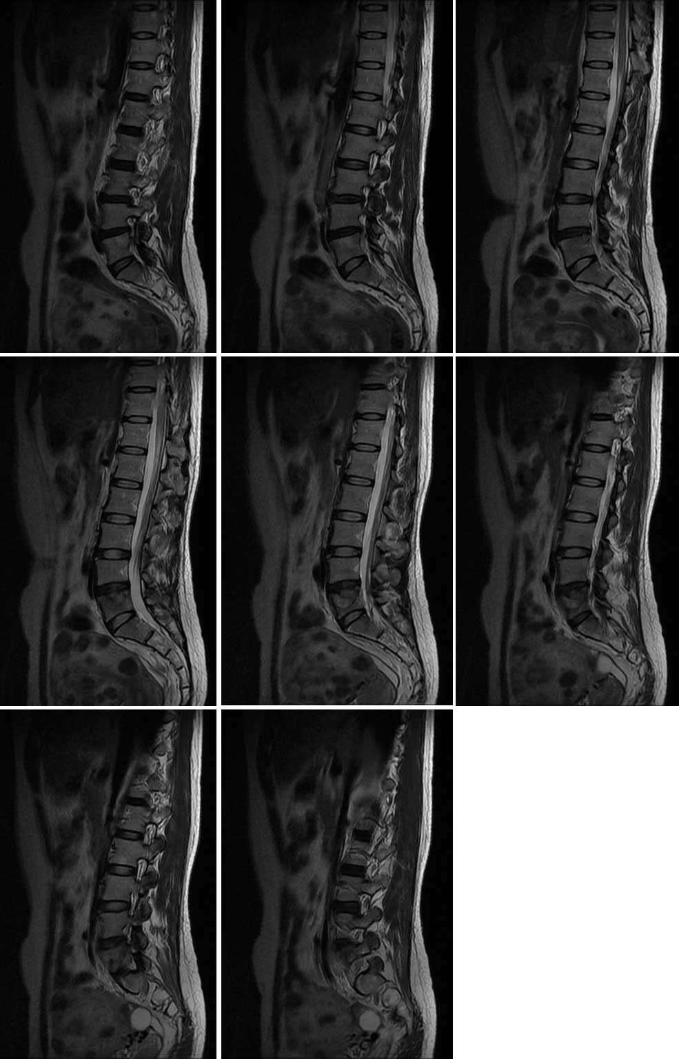 脊柱结核(腰椎) - 骨,关节,肌肉 医影在线