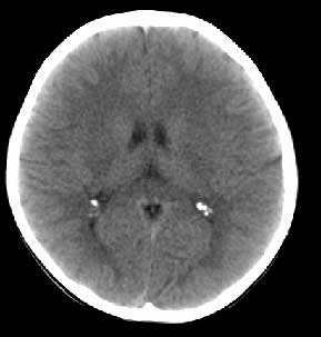 ct040:颅脑病例—脉络丛钙化