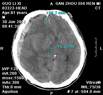 zt0001:ct测量脑中线移位预测脑疝