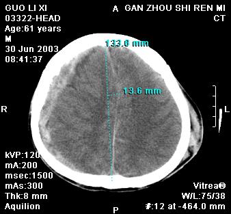 zt0001:ct测量脑中线移位预测脑疝
