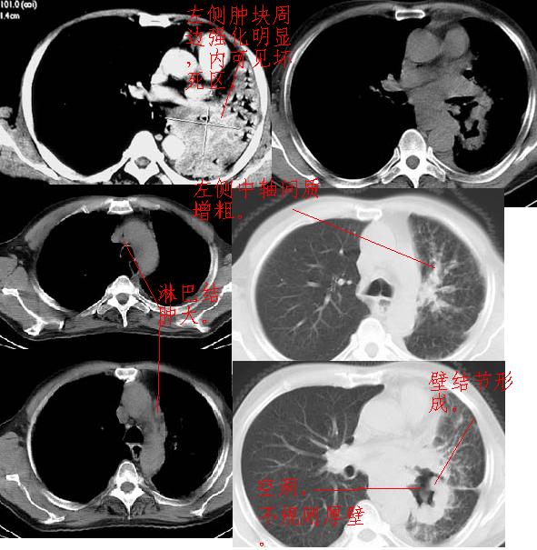 左侧癌性淋巴管炎,纵隔淋巴结转移.胸下段食道受侵